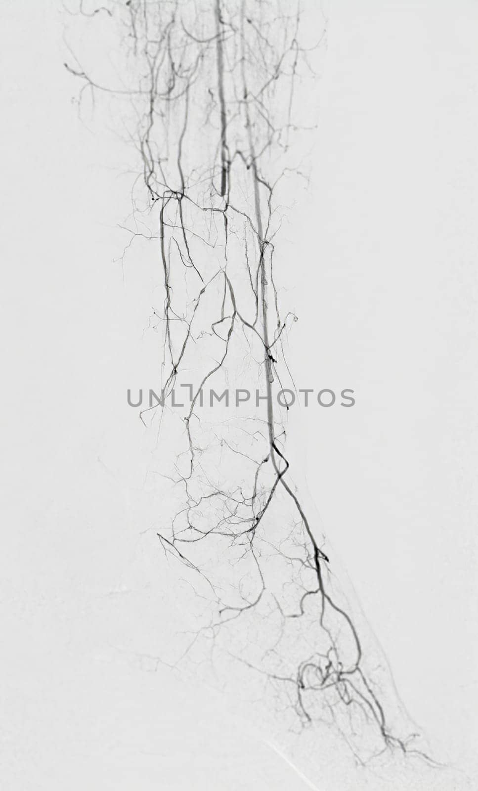 Femoral artery angiogram or angiography at lower extremity area.