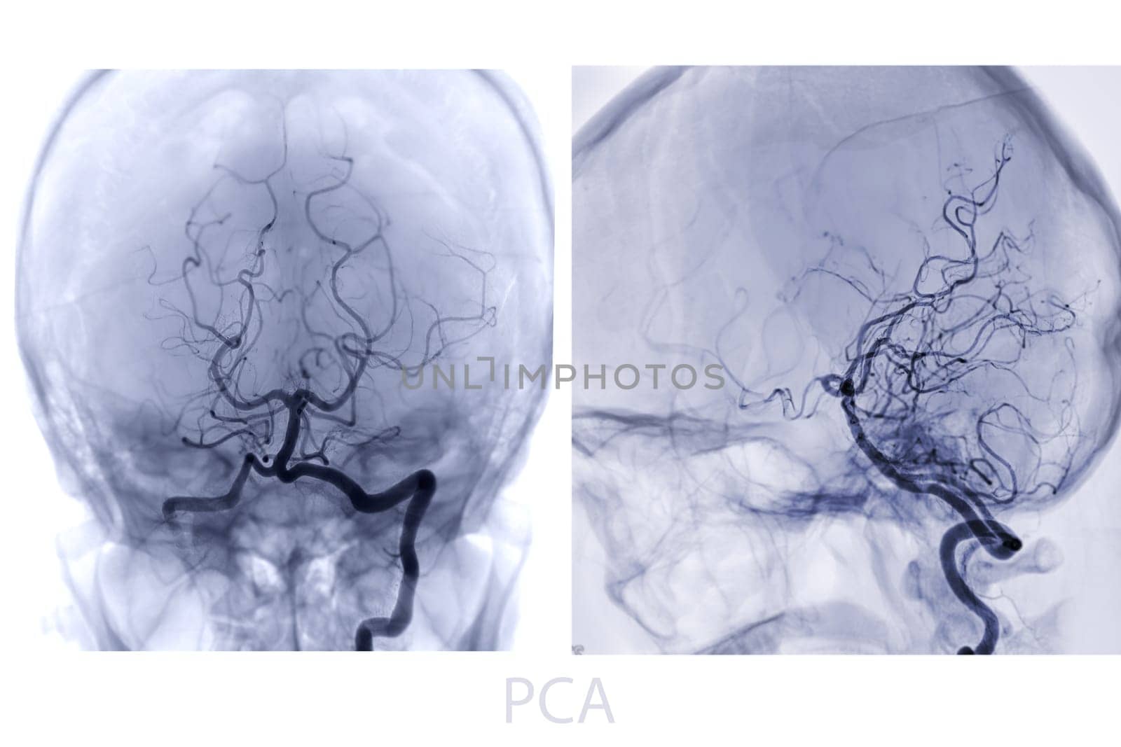 Cerebral angiography image from Fluoroscopy in intervention radiology showing cerebral artery. by samunella