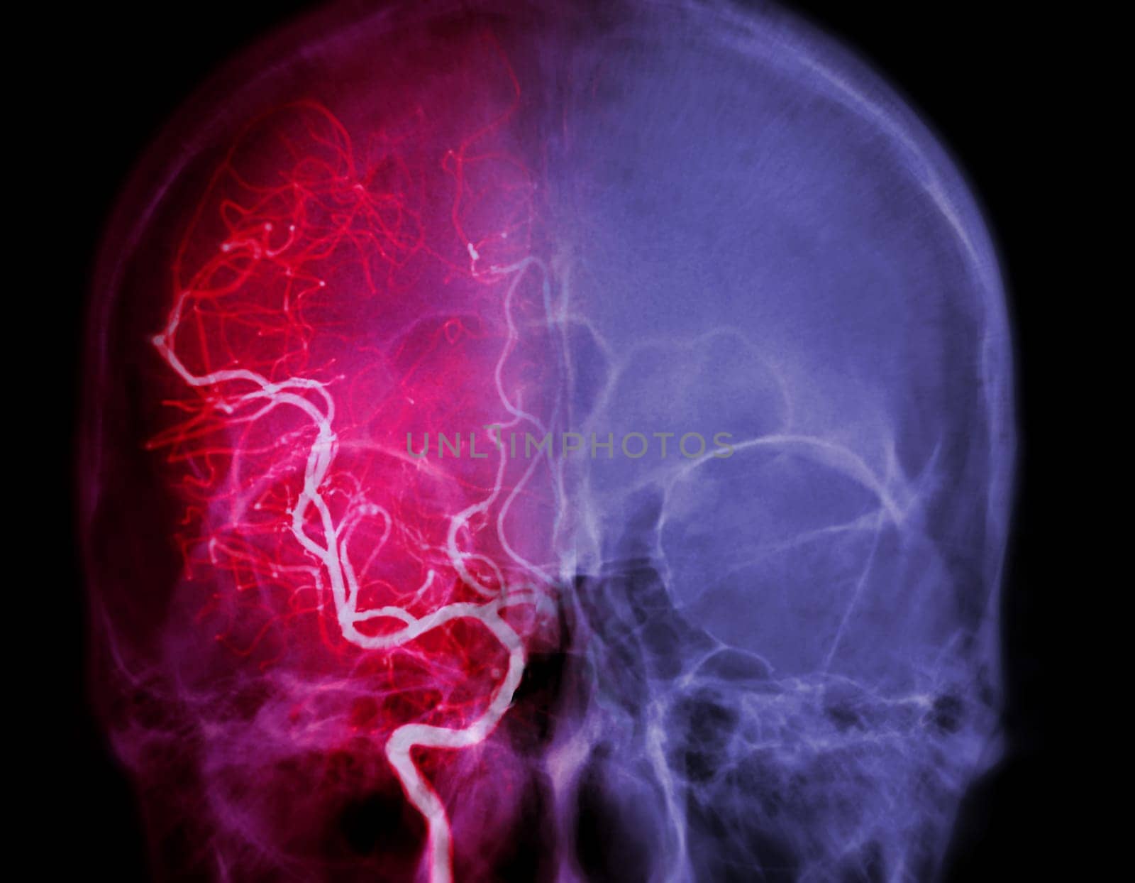 Cerebral angiography image from Fluoroscopy in intervention radiology showing cerebral artery. by samunella