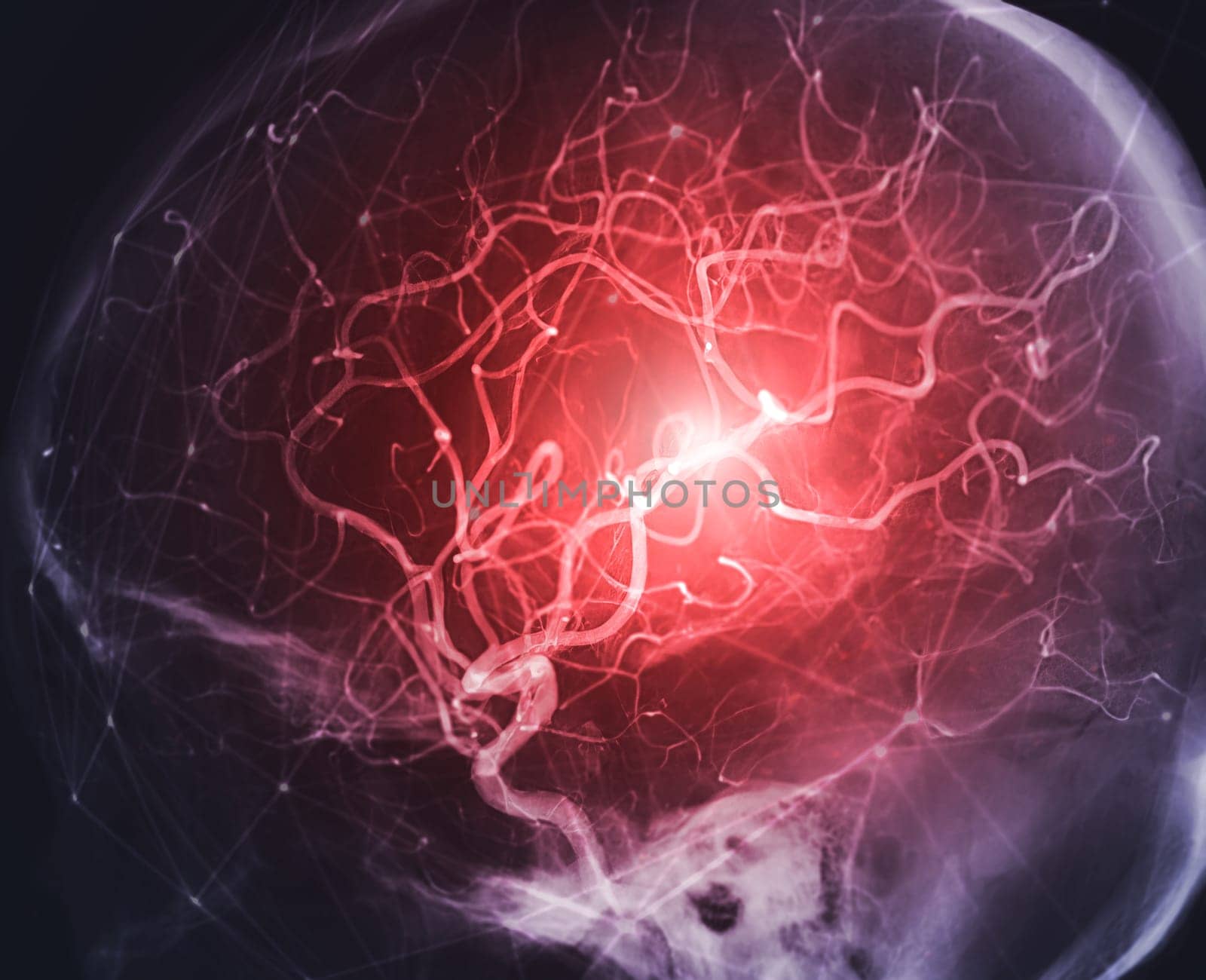 Cerebral angiography image from Fluoroscopy in intervention radiology showing cerebral artery.