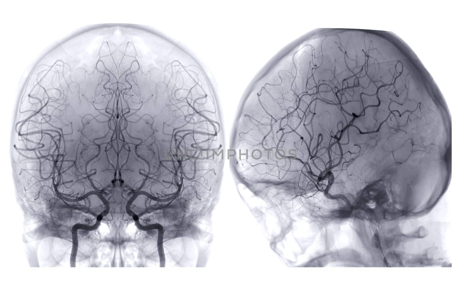 Cerebral angiography image from Fluoroscopy in intervention radiology showing cerebral artery. by samunella