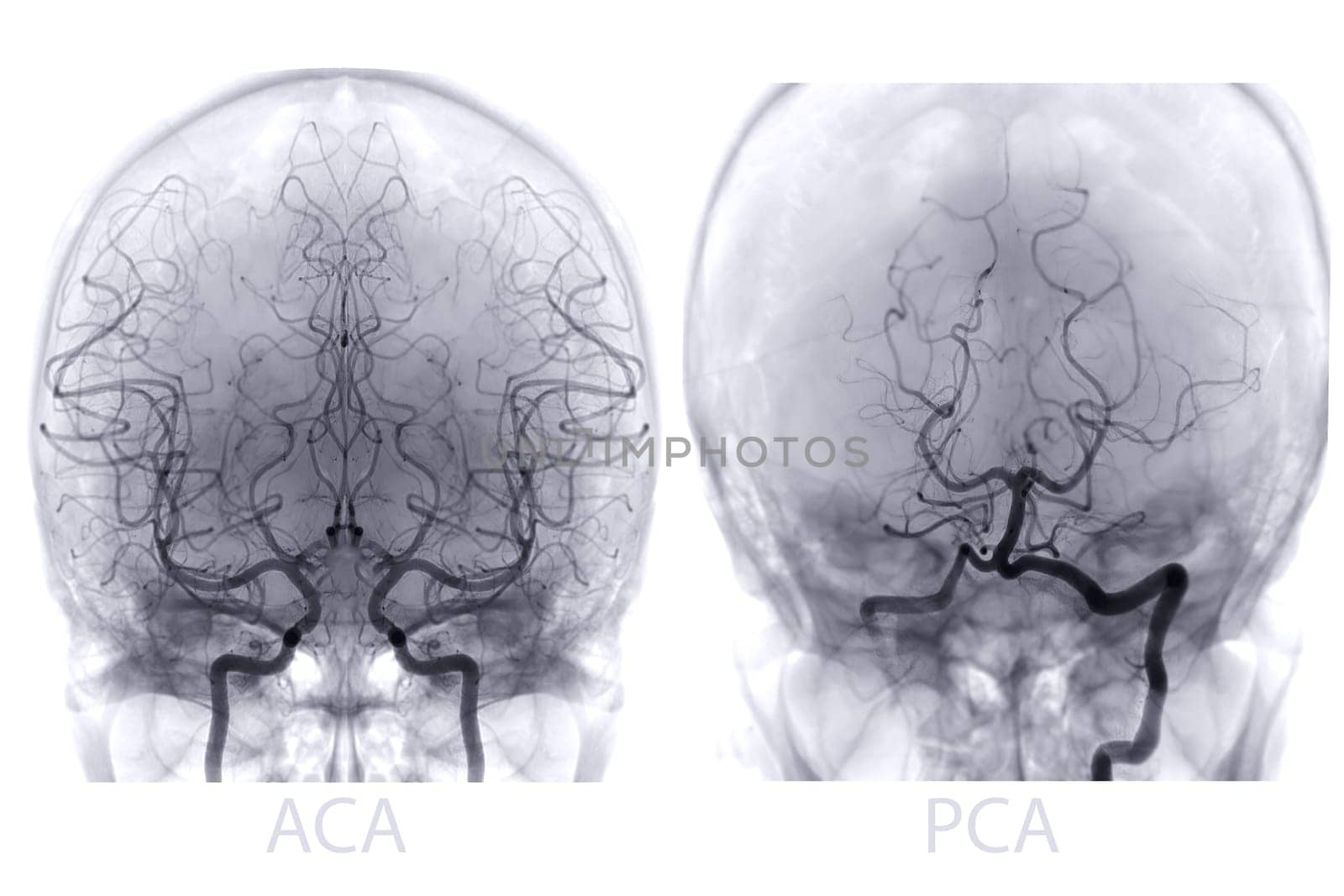 Cerebral angiography image from Fluoroscopy in intervention radiology showing cerebral artery. by samunella