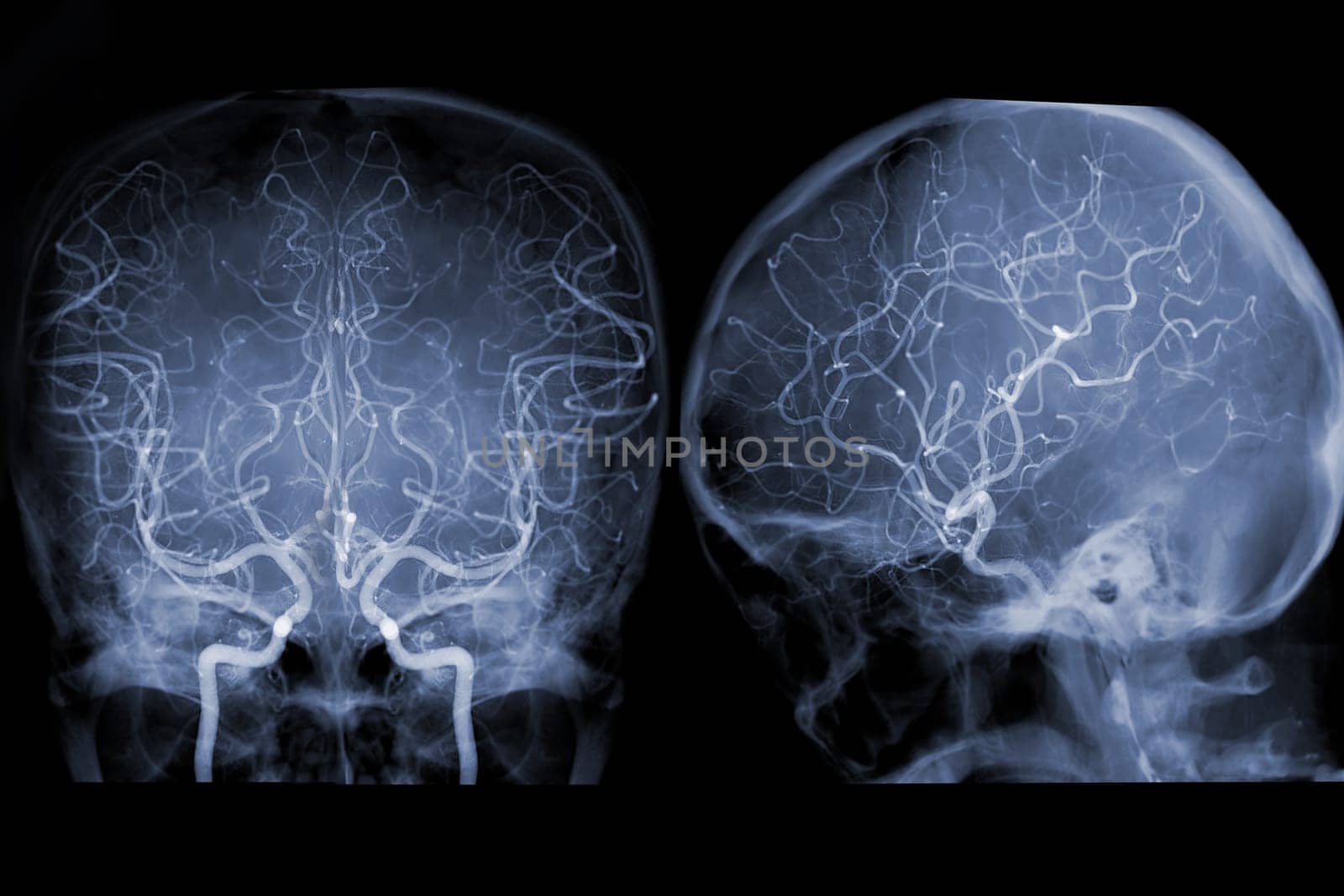 Cerebral angiography image from Fluoroscopy in intervention radiology showing cerebral artery.