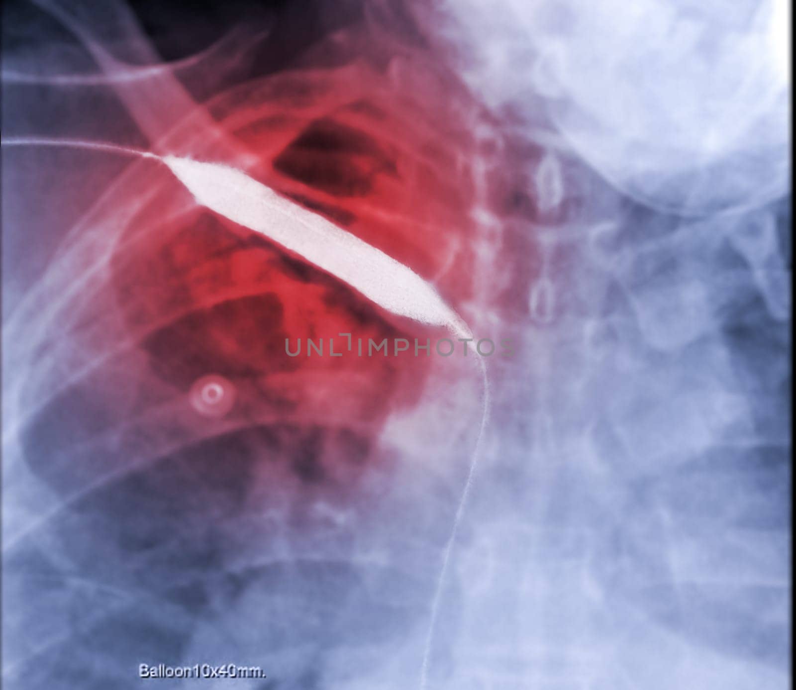 Image of Angioplasty, balloon angioplasty and percutaneous transluminal angioplasty (PTA) .