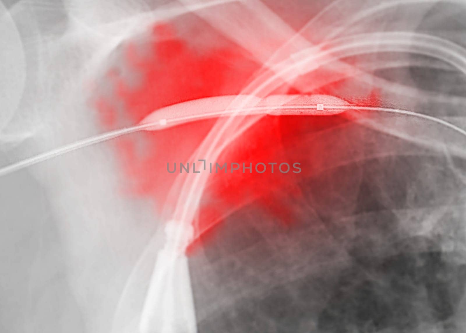 Image of Angioplasty, balloon angioplasty and percutaneous transluminal angioplasty (PTA) .