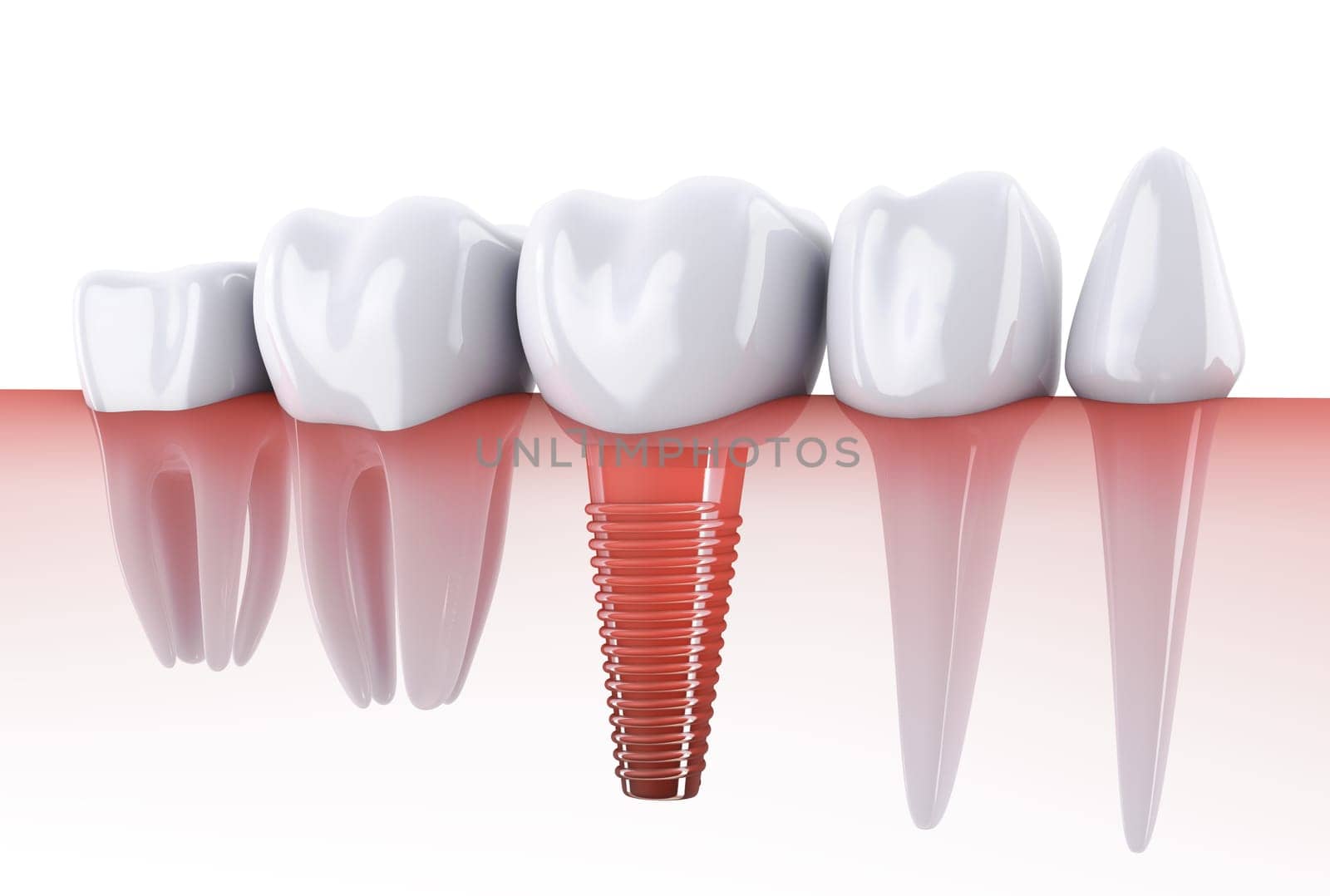 Molars and implant in the jaw bone. 3d render.