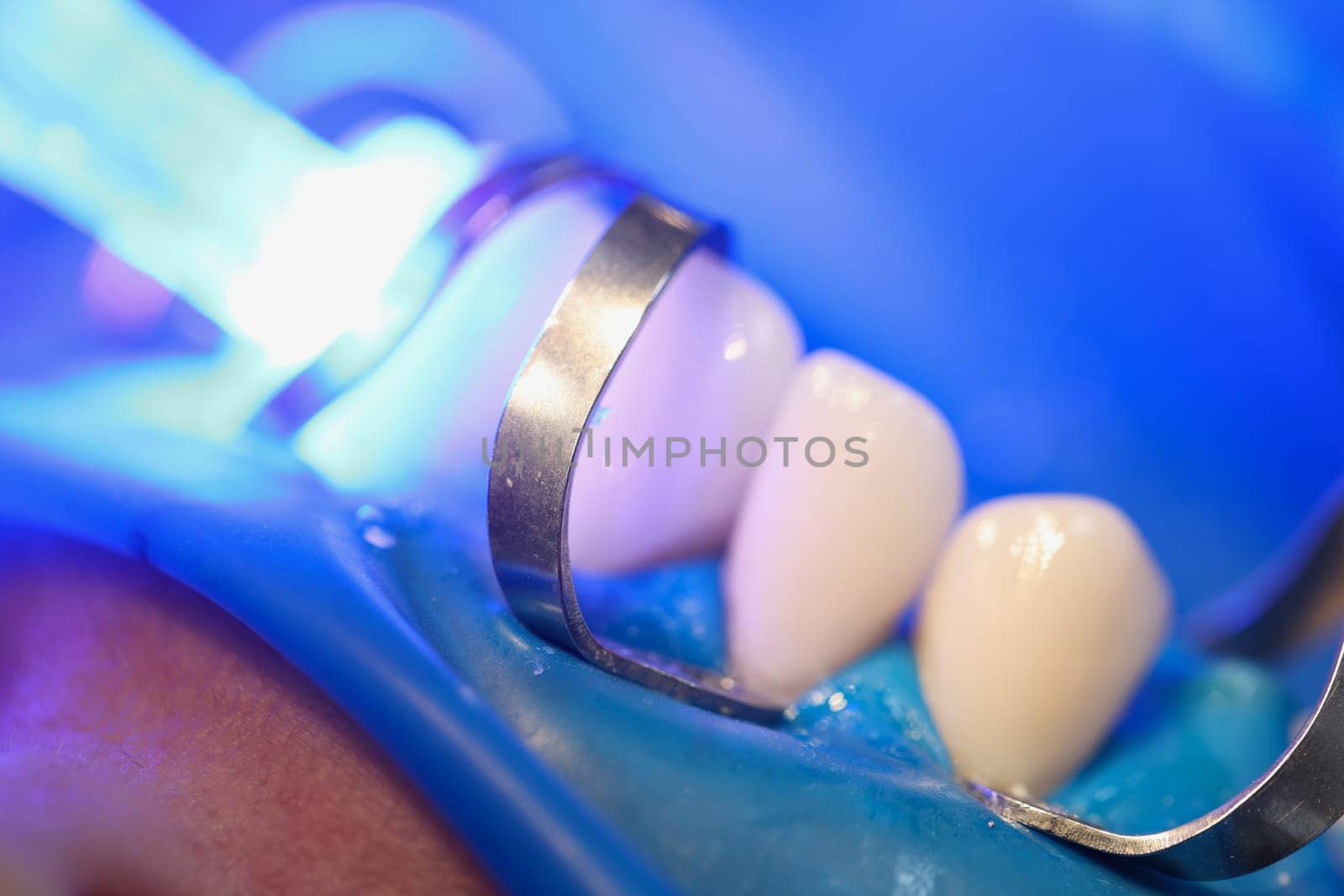 Light falling on teeth during installation of veneers in dental clinic closeup by kuprevich