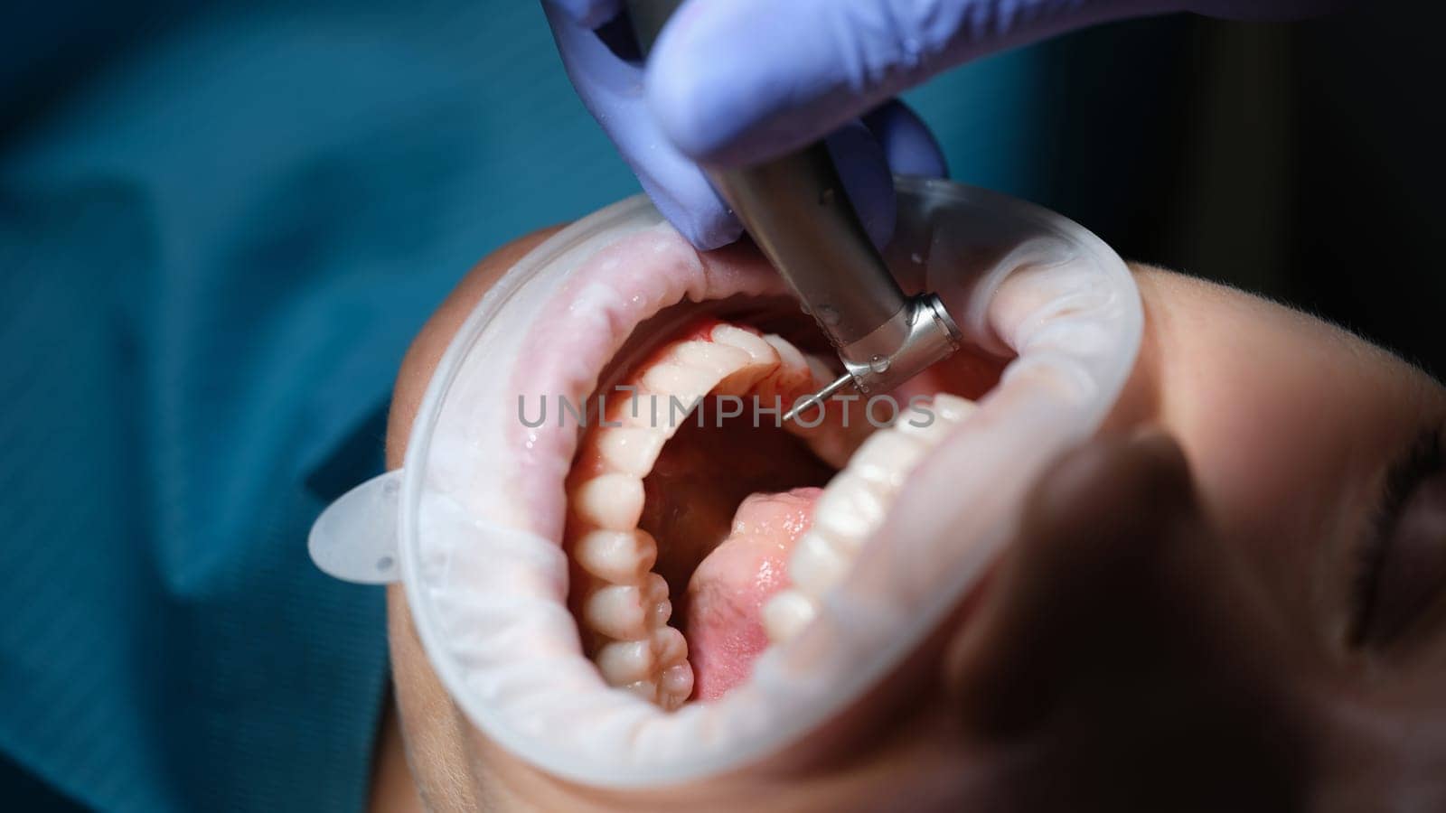 Dentist treating patient teeth with drill in dental clinic closeup. Diagnosis and treatment of caries modern methods concept