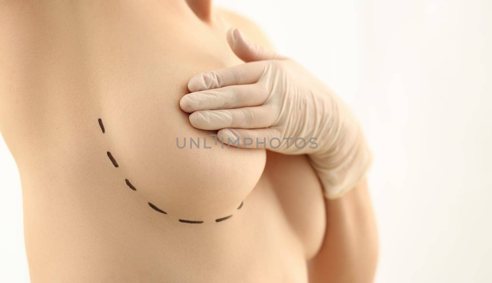 Beautiful woman covering breasts with black surgical lines. Plastic surgery and breast augmentation and lift