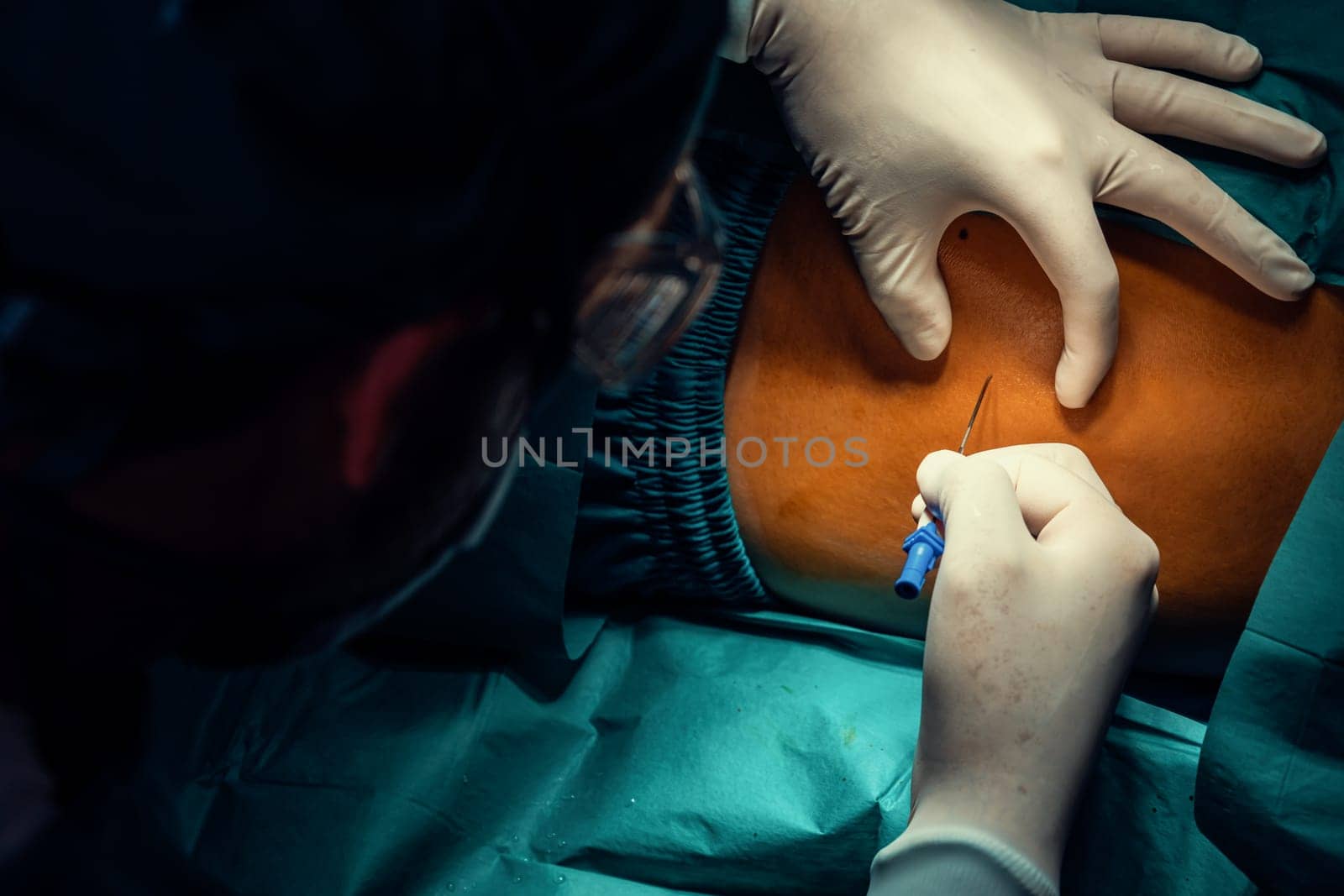 Surgeon inject anesthesia with syringe into the patient before perform surgery in sterile operation room with modern surgical equipments. Medical surgery perform by professional and confident surgeon.