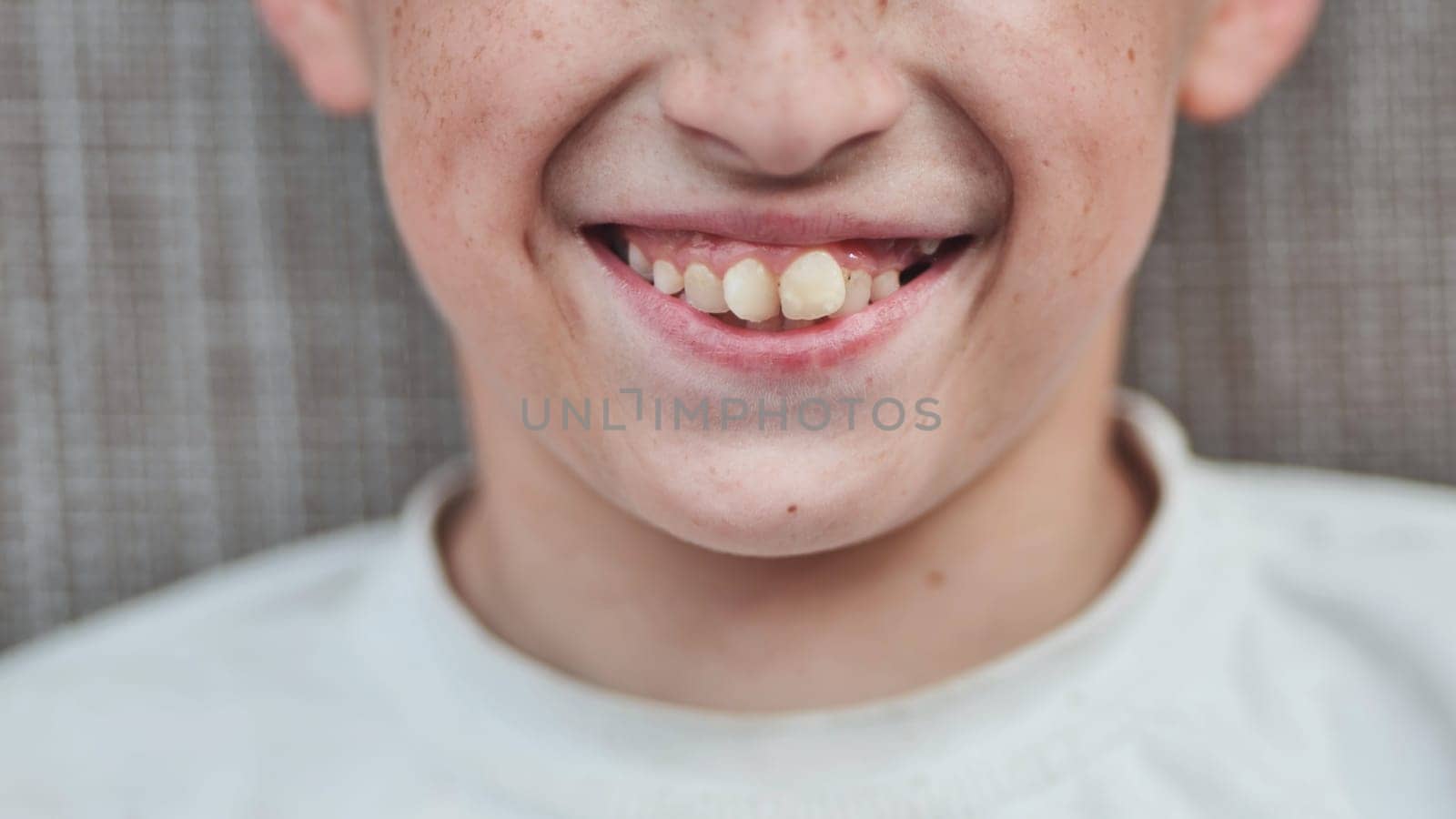 The boy's front crooked teeth in summer. by DovidPro