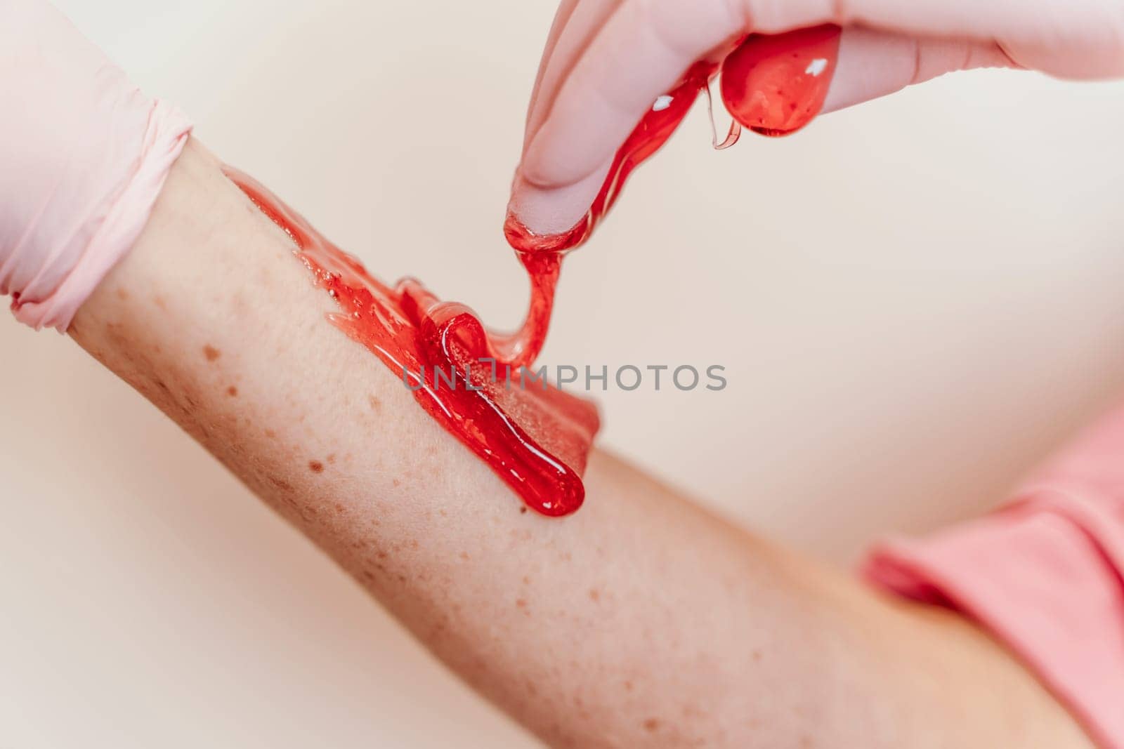 Shugaring master applying thick sugar paste on lady's hand, removing unwanted hair. Hair removal with a special sugar paste has many advantages over wax depilation by Matiunina