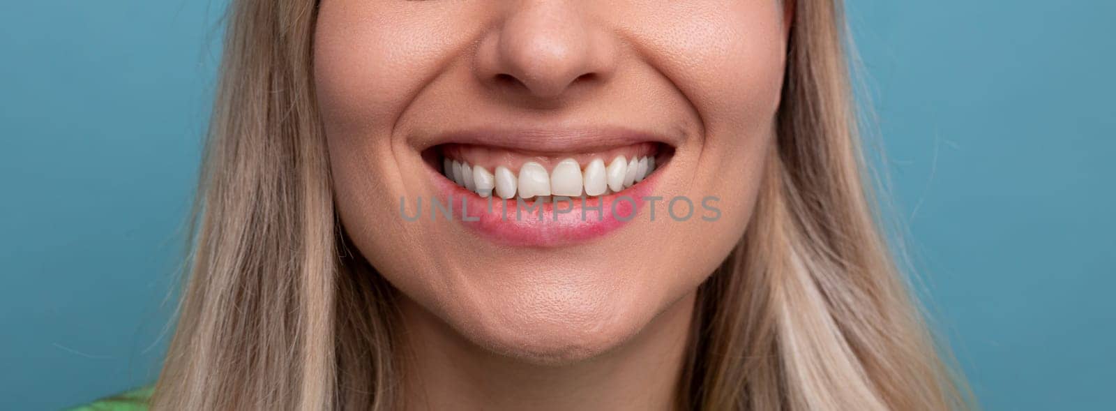 close-up of a female snow-white Hollywood smile on a blue background by TRMK