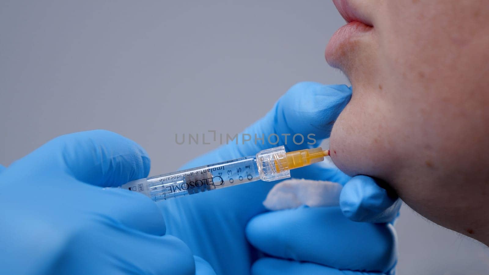 A doctor inserts painkillers into the chin area of womans face