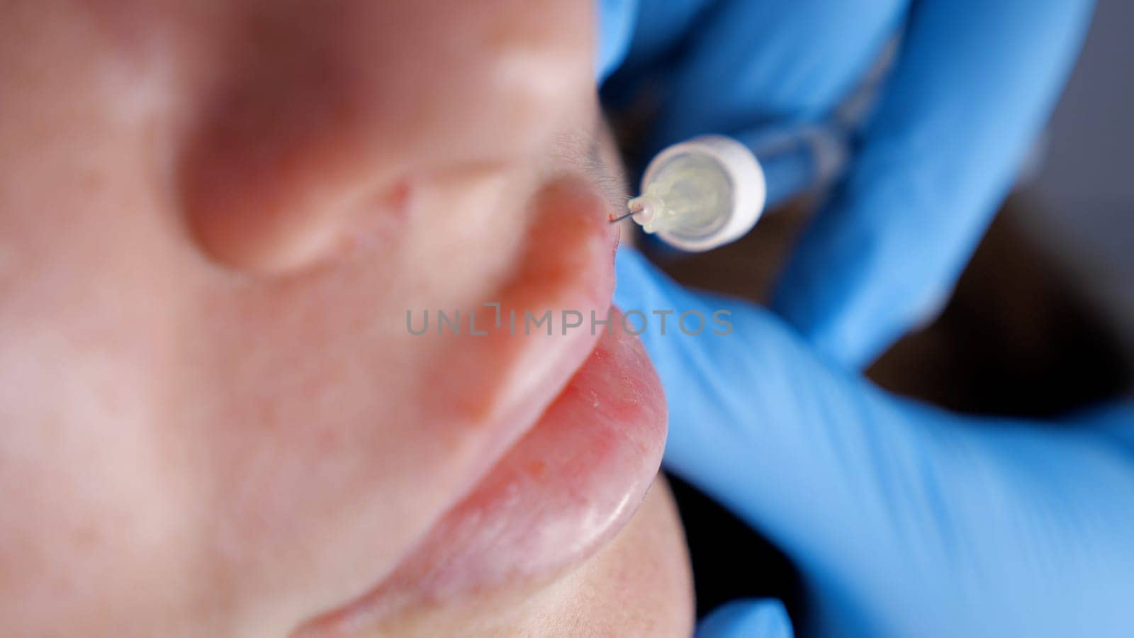 close-up, female face. Surgeon, in medical gloves, carefully and slowly injects hyaluronic acid into woman's lips with a syringe. lip augmentation procedure. beauty injections. Plastic surgery
