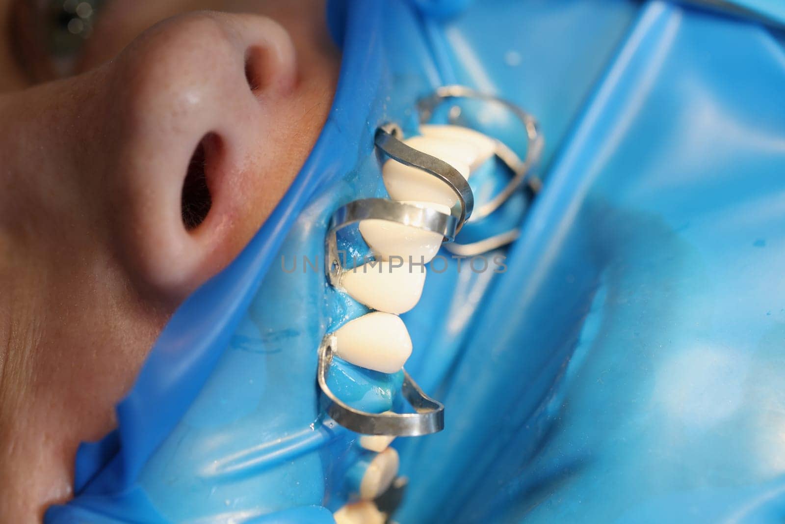 Patient at dentist office to install dentures or veneers closeup. Dental prosthetics concept