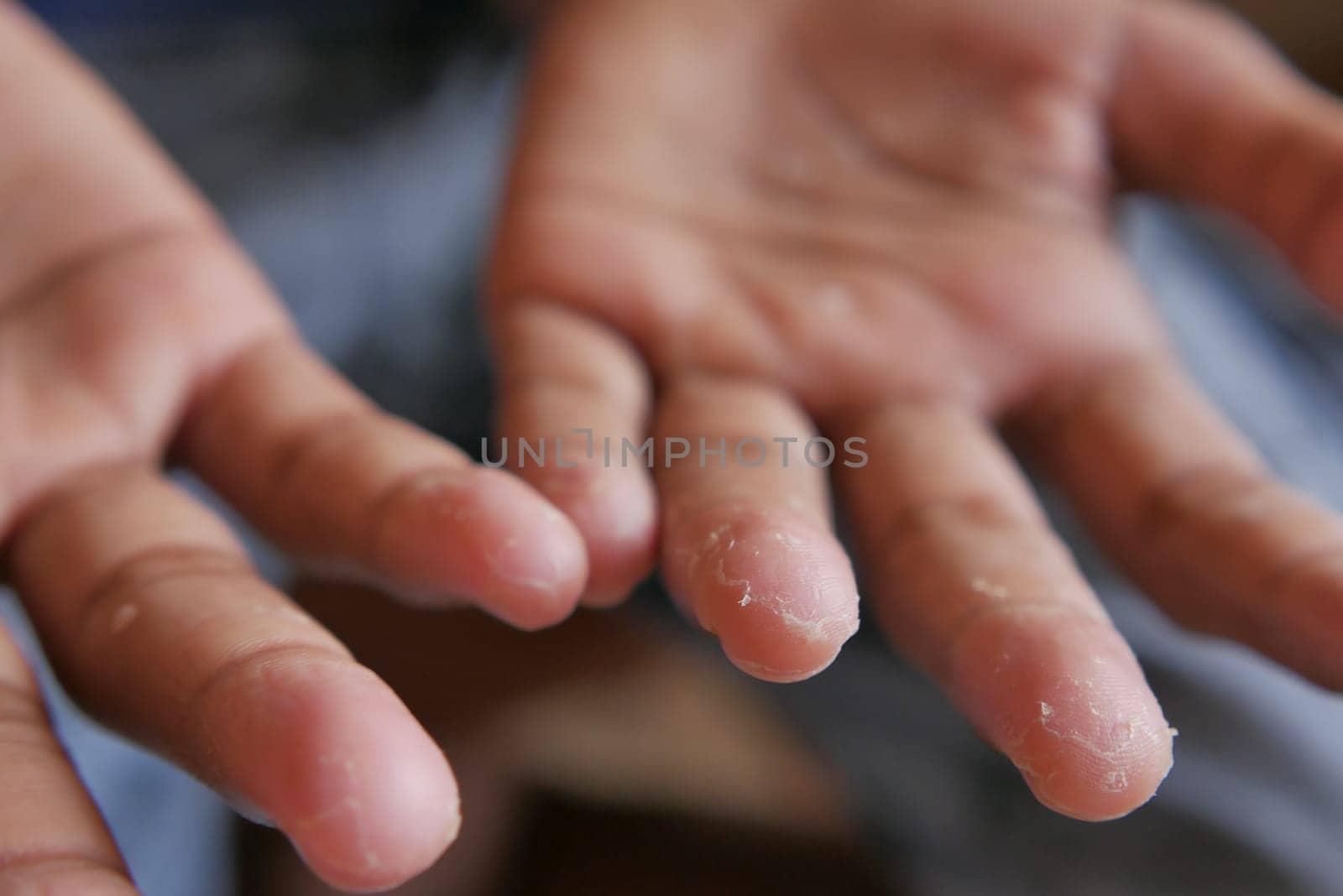close up of Dry cracked skin of a men's hand by towfiq007
