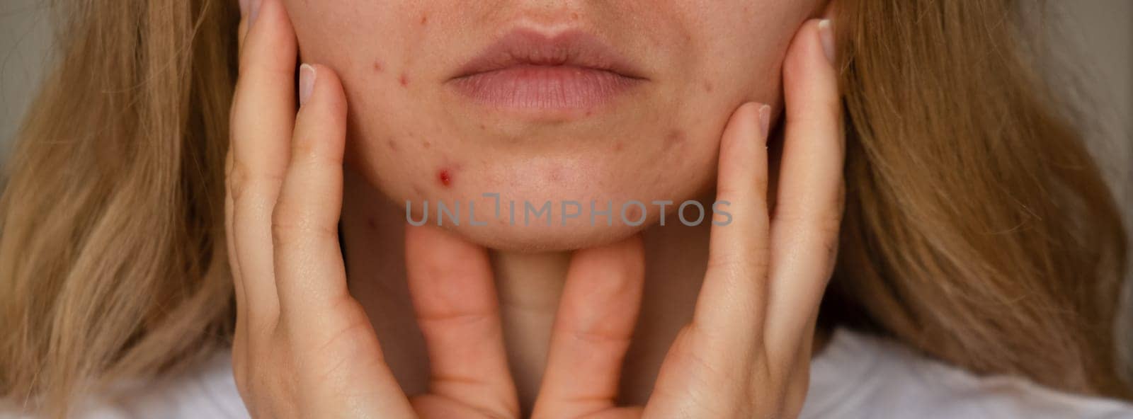 Unrecognizable woman showing her acne on face. Close-up acne on woman's face with rash skin ,scar and spot that allergic to cosmetics. Banner Problem skincare and health concept. Wrinkles, melasma, dark spots, freckles, dry skin, acne blackheads on face middle age women chin acne problem. pimples on the beard. problem skin in a young girl. hormonal misbalance. Skin disorders lead to depression and insecurities in women