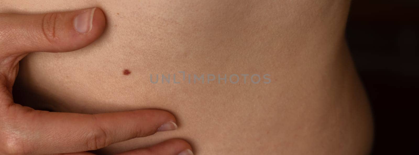 Unrecognizable woman showing her Birthmarks on skin Close up detail of the bare skin Banner Sun Exposure effect on skin, Health Effects of UV Radiation Woman with birthmarks Pigmentation by anna_stasiia