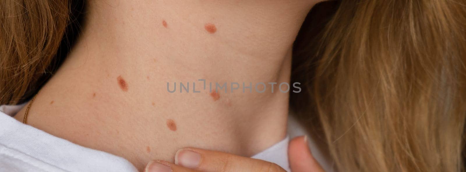 Unrecognizable woman showing her Birthmarks on neck skin Close up detail of the bare skin Sun Exposure effect on skin, Banner Health Effects of UV Radiation Woman with birthmarks Pigmentation and lot of birthmarks