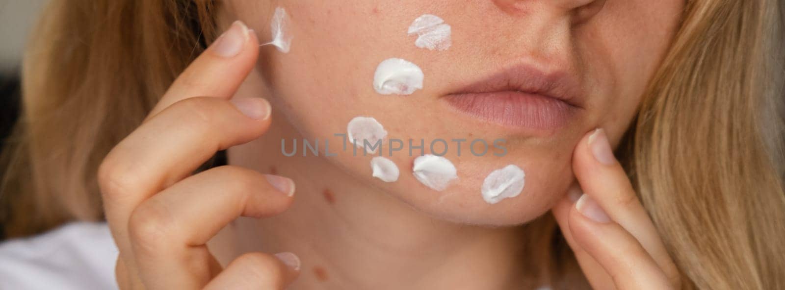 Unrecognizable woman applies makeup, cream serum cure for acne on face. Close-up acne on woman's face with rash skin ,scar and spot that allergic to cosmetics. Banner Problem skincare and health concept. Wrinkles, melasma, dark spots, freckles, dry skin, acne blackheads on face middle age women chin acne problem. pimples on the beard. problem skin in a young girl. hormonal misbalance. Skin disorders lead to depression and insecurities in women