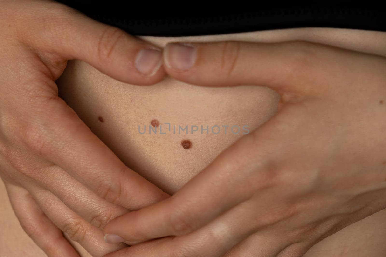 Unrecognizable woman showing her Birthmarks on skin Close up detail of the bare skin Sun Exposure effect on skin, Health Effects of UV Radiation Woman with birthmarks Pigmentation and lot of birthmarks