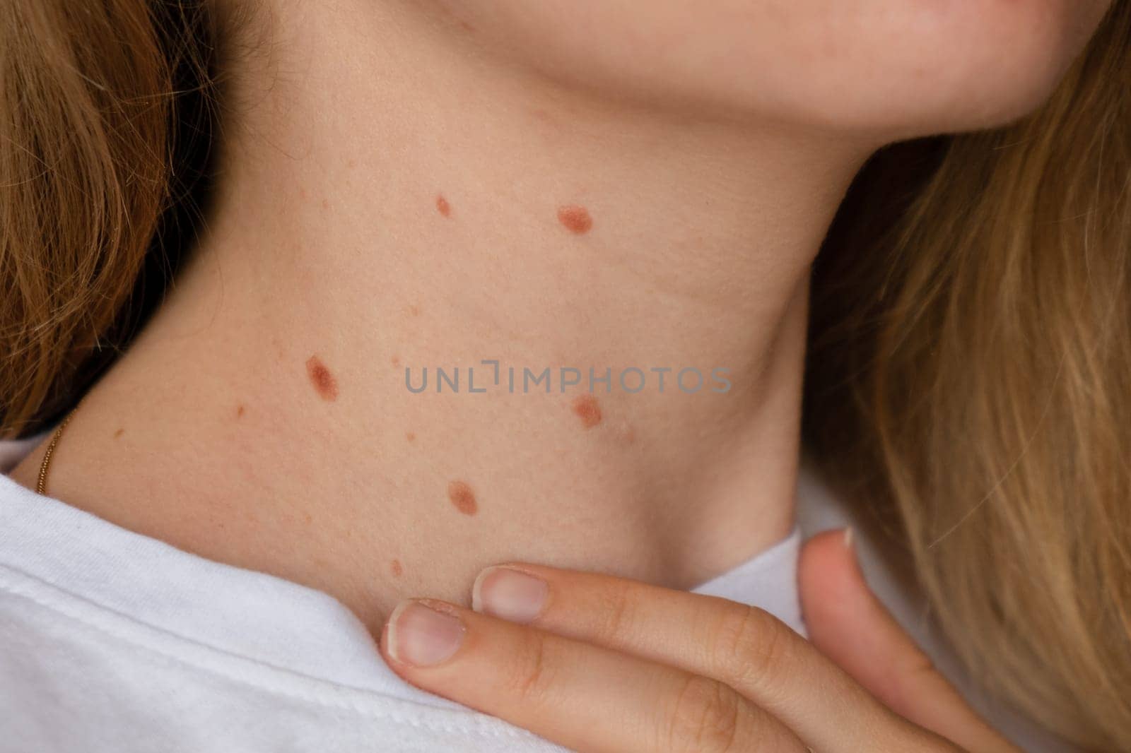 Unrecognizable woman showing her Birthmarks on neck skin Close up detail of the bare skin Sun Exposure effect on skin, Health Effects of UV Radiation Woman with birthmarks Pigmentation and lot of birthmarks