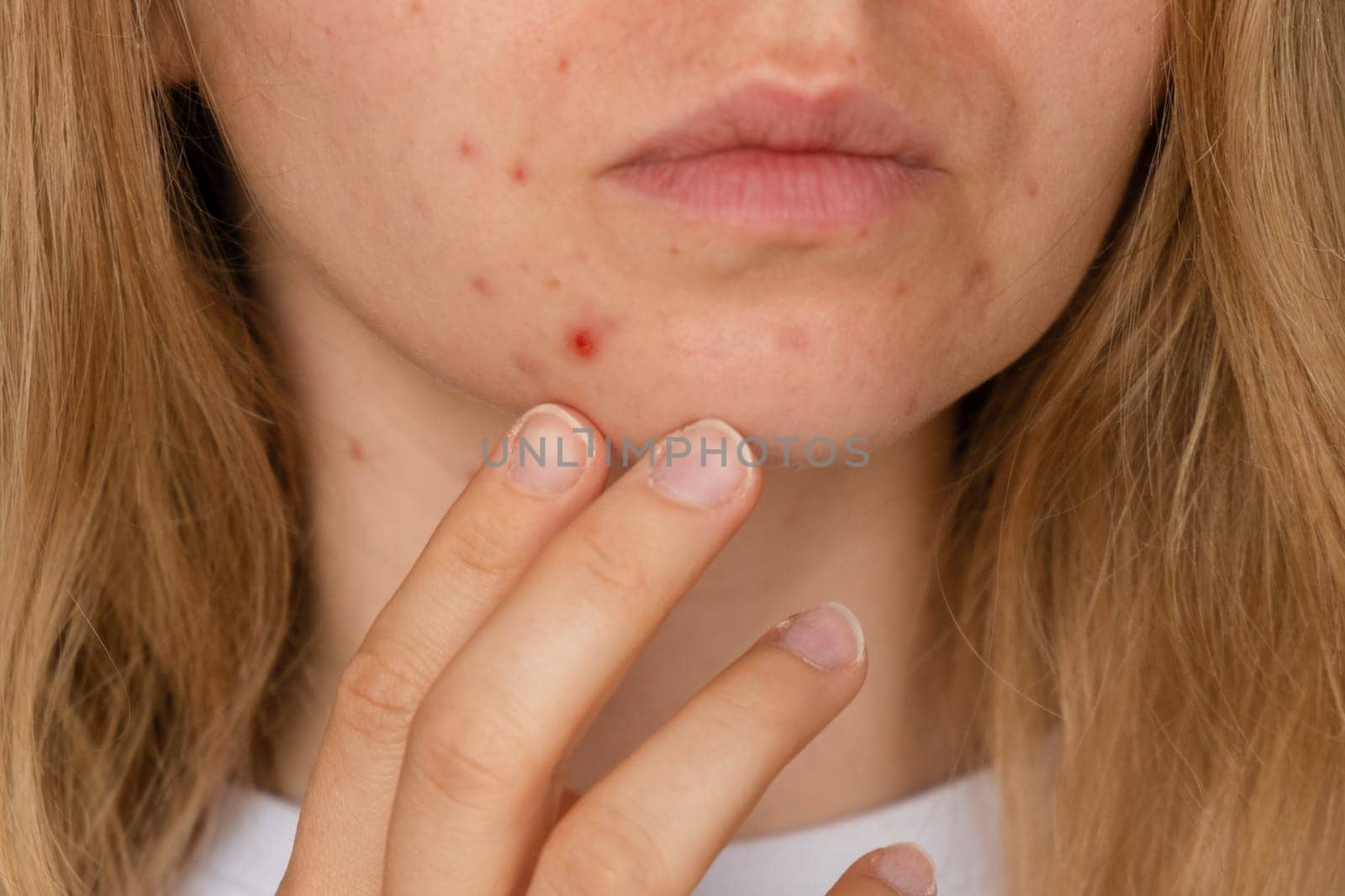 Unrecognizable woman showing her acne on face. Close-up acne on woman's face with rash skin ,scar and spot that allergic to cosmetics. Problem skincare and health concept. Wrinkles, melasma, dark spots, freckles, dry skin, acne blackheads on face middle age women chin acne problem. pimples on the beard. problem skin in a young girl. hormonal misbalance. Skin disorders lead to depression and insecurities in women