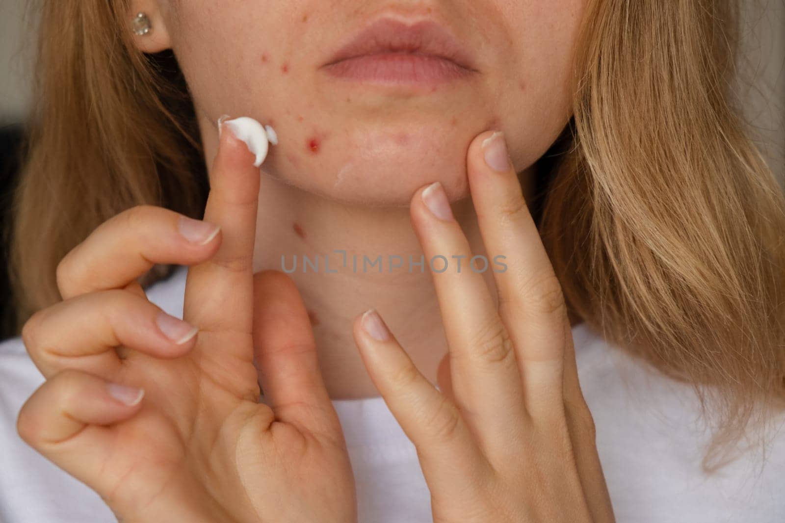 Unrecognizable woman applies makeup, cream serum cure for acne on face. Close-up acne on woman's face with rash skin ,scar and spot that allergic to cosmetics. Problem skincare and health concept. Wrinkles, melasma, dark spots, freckles, dry skin, acne blackheads on face middle age women chin acne problem. pimples on the beard. problem skin in a young girl. hormonal misbalance. Skin disorders lead to depression and insecurities in women