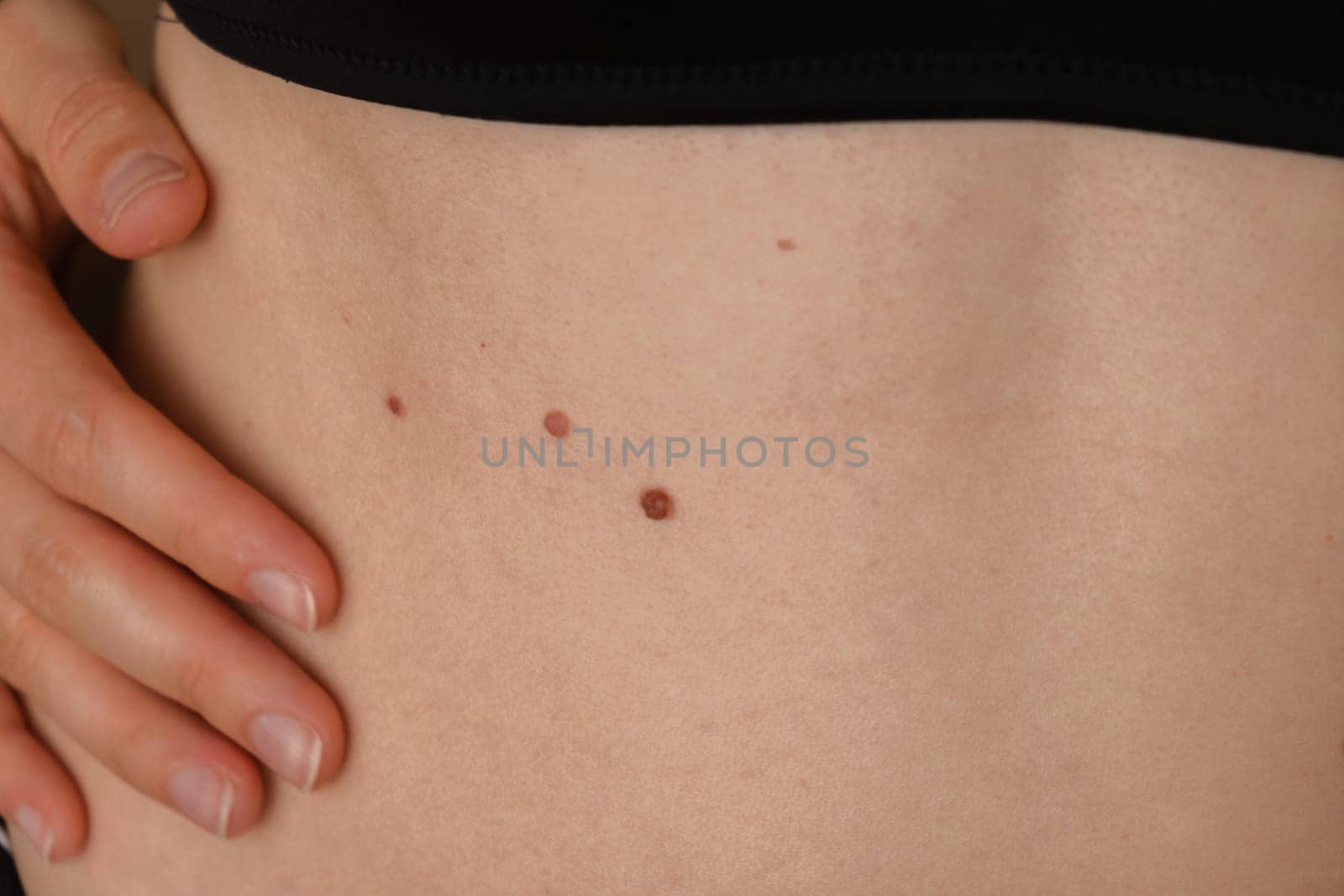 Unrecognizable woman showing her Birthmarks on skin Close up detail of the bare skin Sun Exposure effect on skin, Health Effects of UV Radiation Woman with birthmarks Pigmentation and lot of birthmarks
