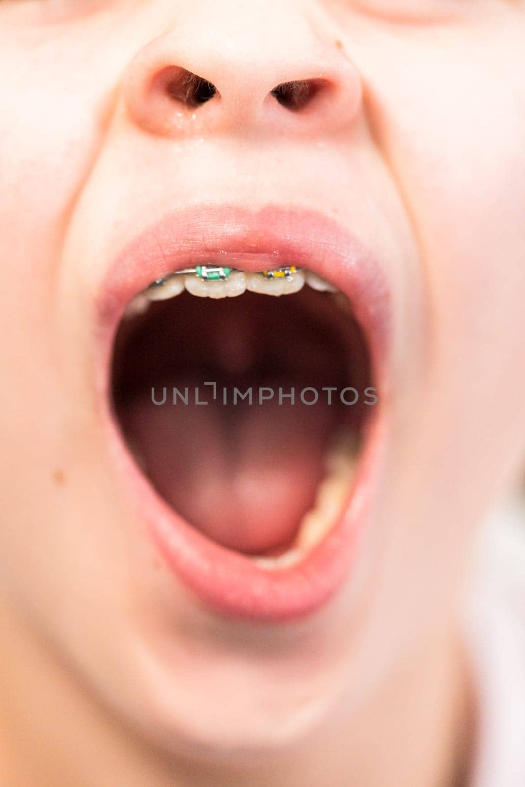 Close-up of the mouth of a girl with rainbow braces.