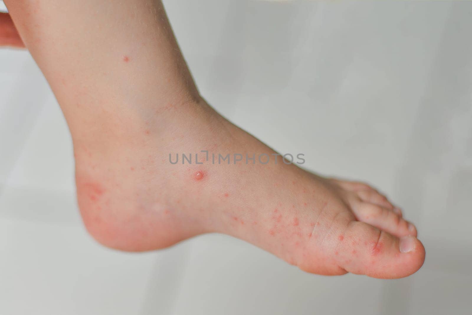 Enterovirus Legs hands mouth Rash on the body of a child Cocksackie virus