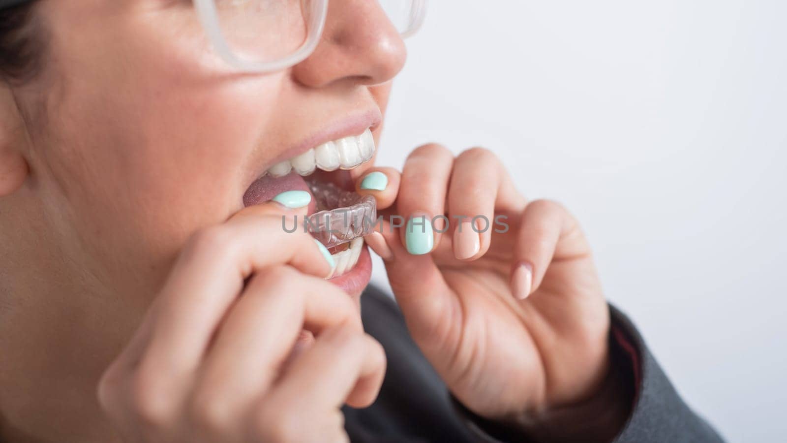 Close-up of a woman putting on transparent plastic retainers. The girl uses a device to straighten her teeth.