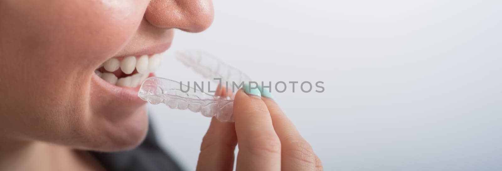 Close-up of a woman putting on transparent plastic retainers. The girl uses a device to straighten her teeth. Widescreen.