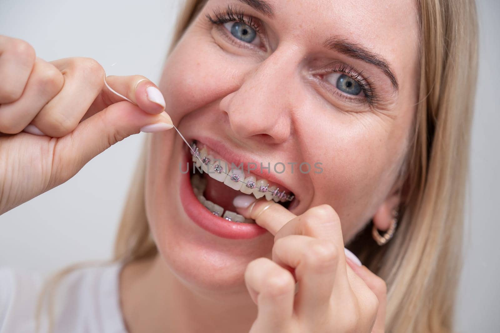 Caucasian woman cleaning her teeth with braces using dental floss. by mrwed54