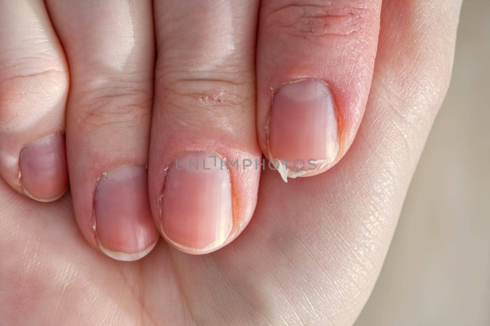 Close-up of brittle nails on woman's hands. Female broken fingernail. weak sore nails.