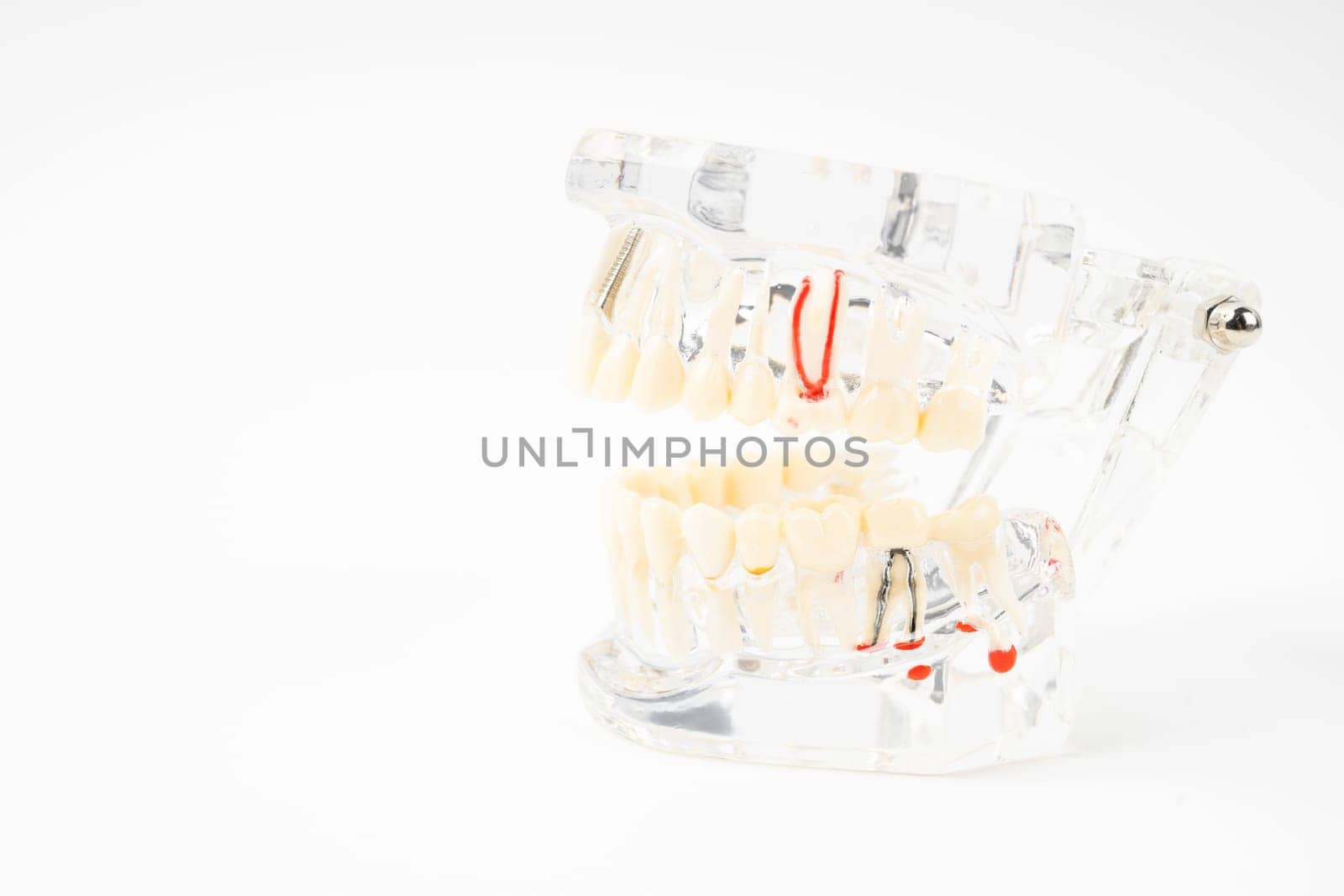 The Dentures model, abutment and human teeth and dentures on white background. by Gamjai