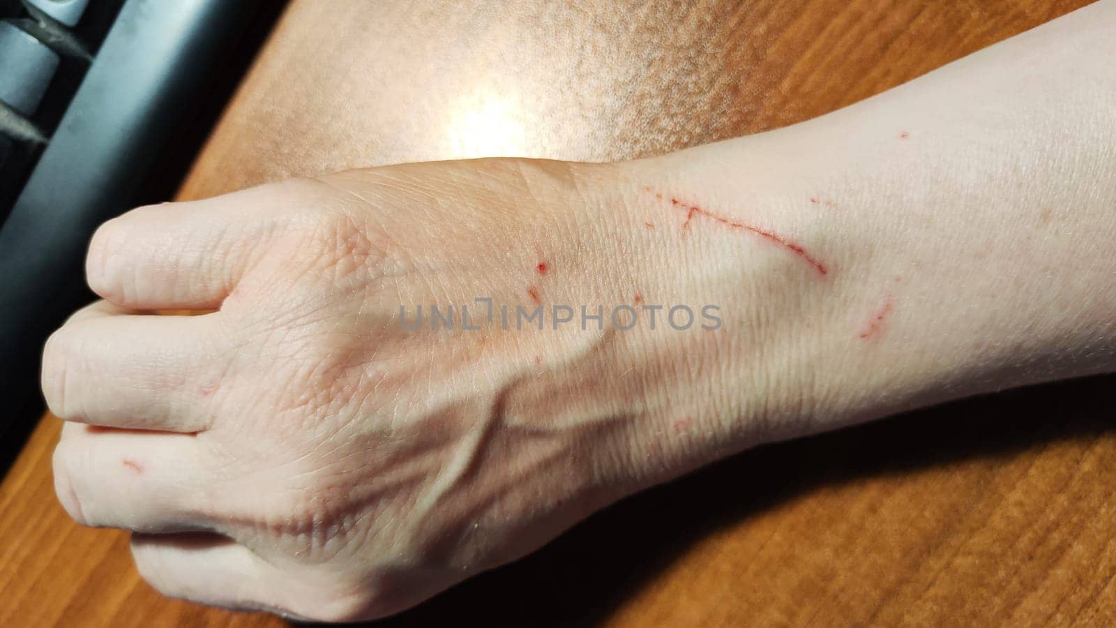 A woman's hand with scratches made by a cat. Minor injuries to the hand. Aggressive animal by keleny