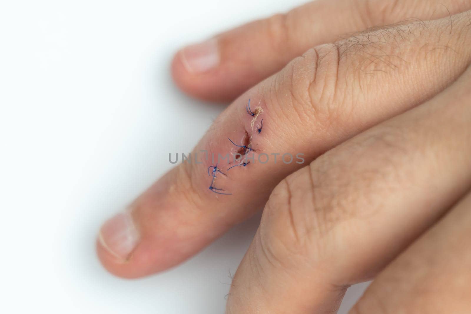 Stitched wound on a finger. Hand with a stitched cut wound