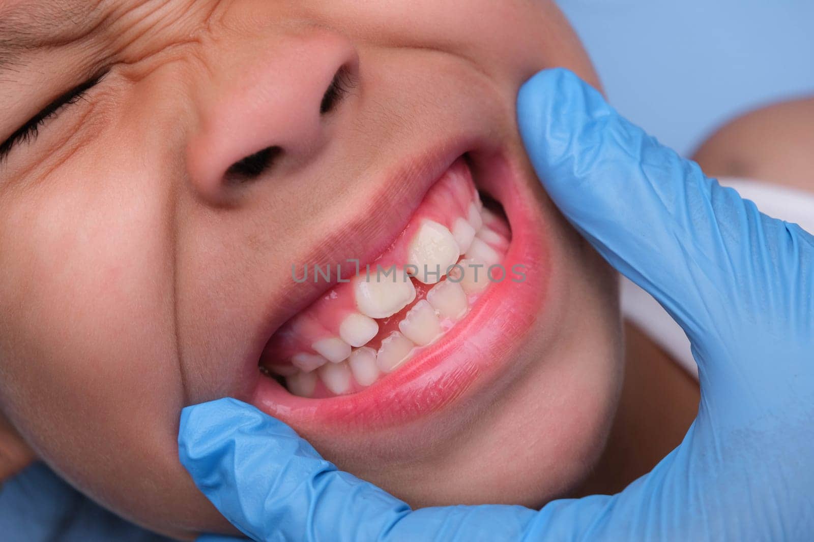 Close-up inside the oral cavity of a healthy child with beautiful rows of baby teeth. Young girl opens mouth revealing upper and lower teeth, hard palate, soft palate, dental and oral health checkup.