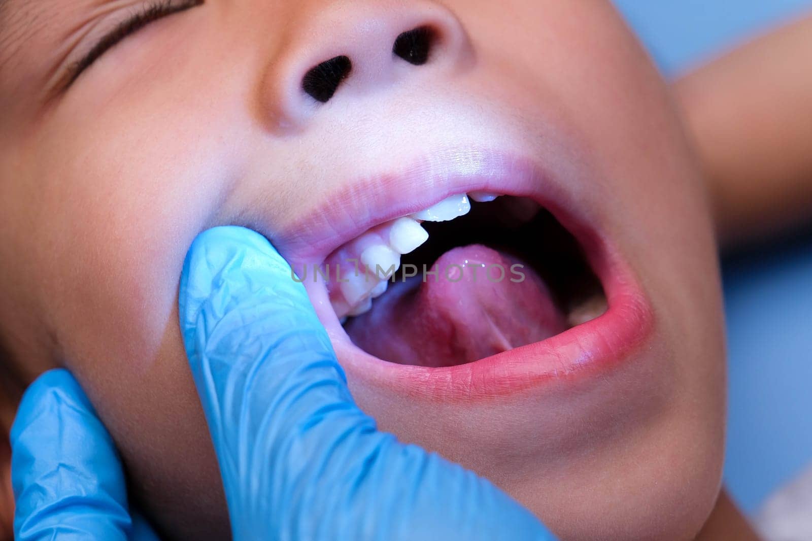 Close-up inside the oral cavity of a healthy child with beautiful rows of baby teeth. Young girl opens mouth revealing upper and lower teeth, hard palate, soft palate, dental and oral health checkup. by TEERASAK