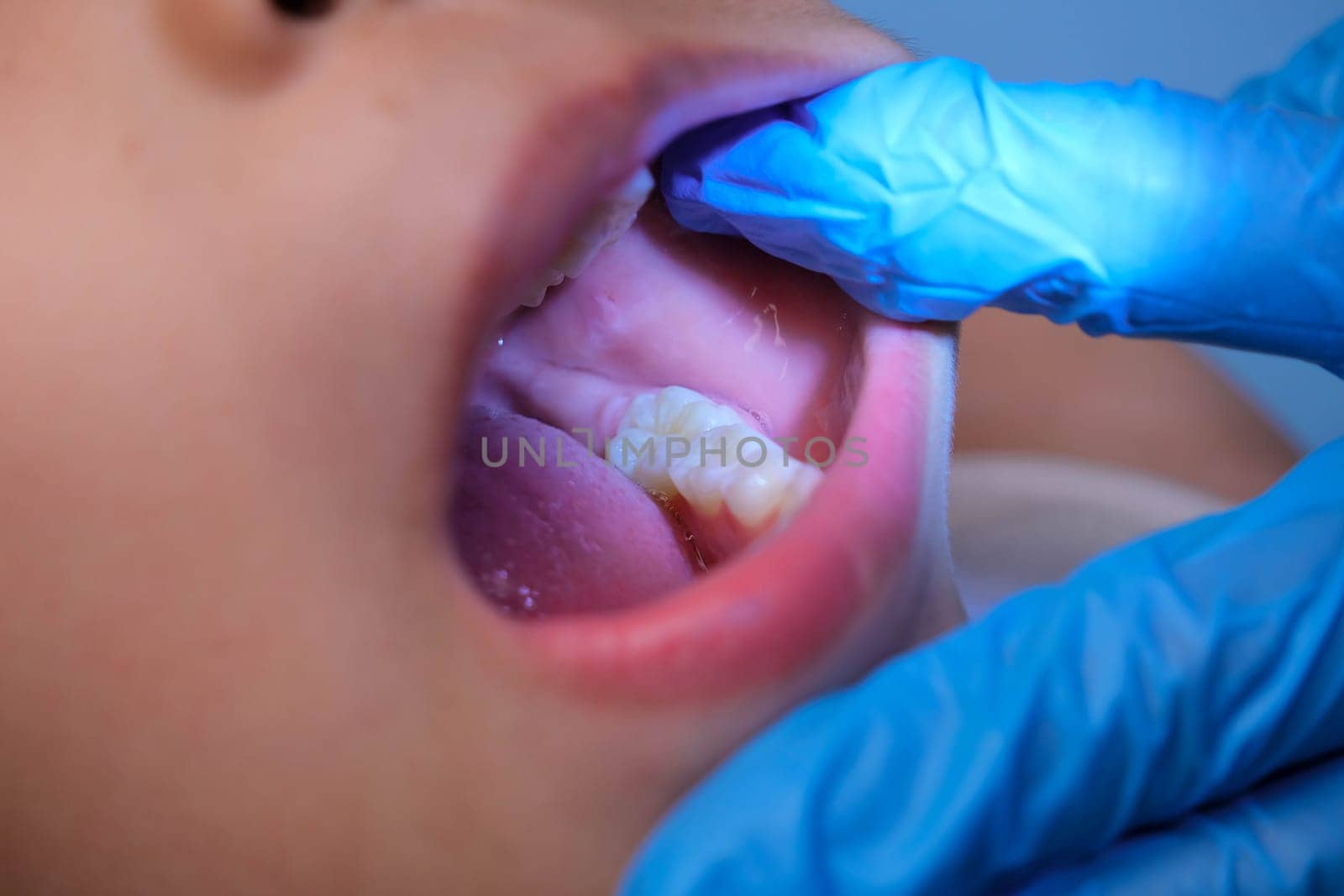 Close-up inside the oral cavity of a healthy child with beautiful rows of baby teeth. Young girl opens mouth revealing upper and lower teeth, hard palate, soft palate, dental and oral health checkup.