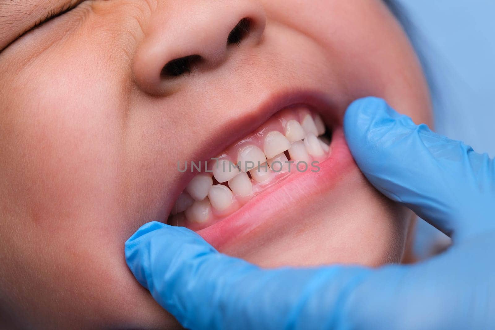 Close-up inside the oral cavity of a healthy child with beautiful rows of baby teeth. Young girl opens mouth revealing upper and lower teeth, hard palate, soft palate, dental and oral health checkup.