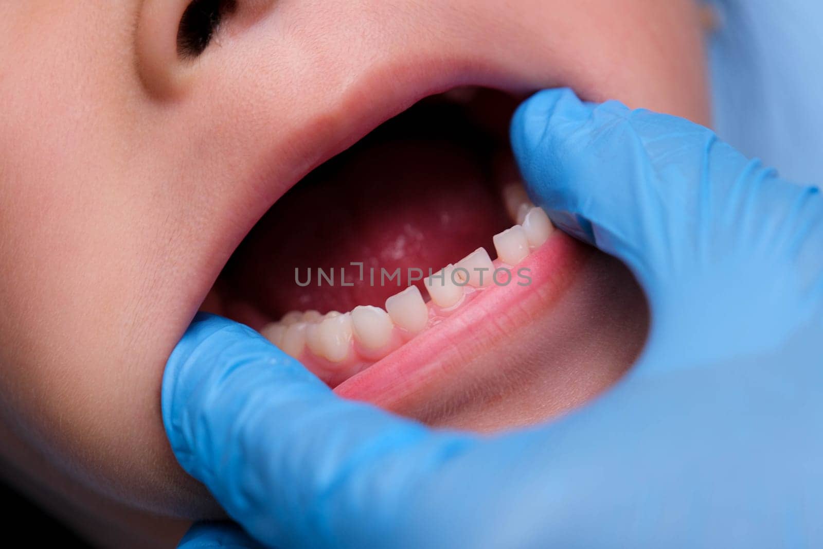 Close-up inside the oral cavity of a healthy child with beautiful rows of baby teeth. Young girl opens mouth revealing upper and lower teeth, hard palate, soft palate, dental and oral health checkup. by TEERASAK