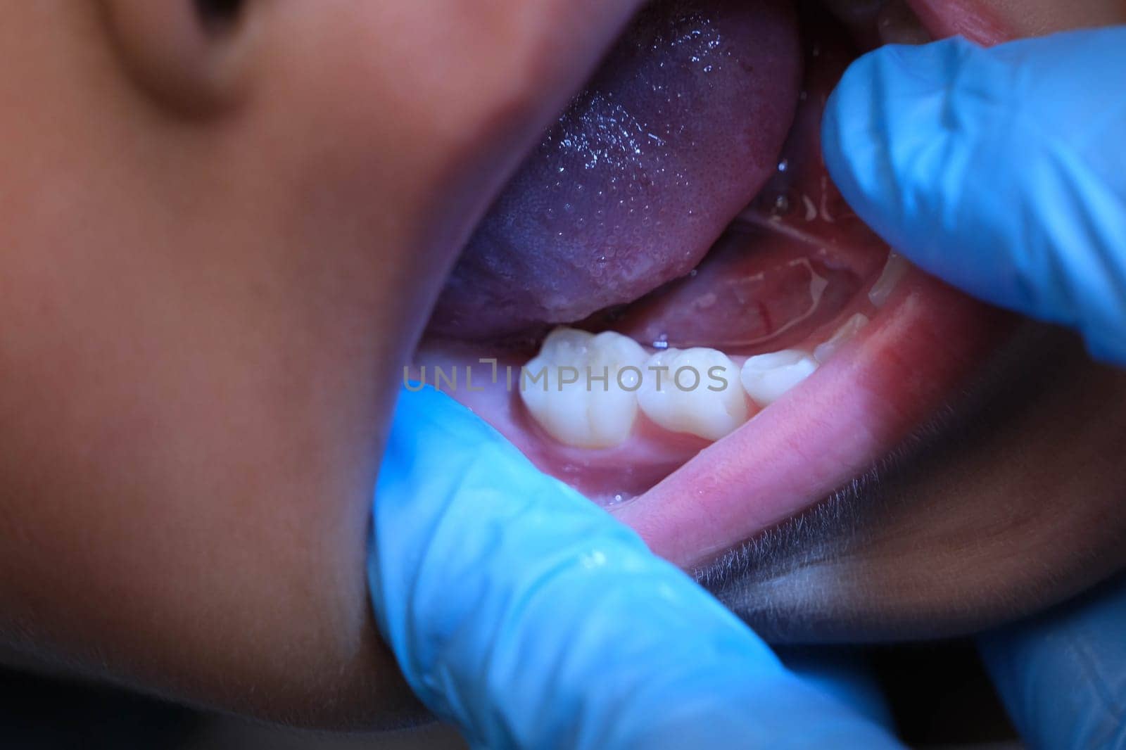 Close-up inside the oral cavity of a healthy child with beautiful rows of baby teeth. Young girl opens mouth revealing upper and lower teeth, hard palate, soft palate, dental and oral health checkup. by TEERASAK