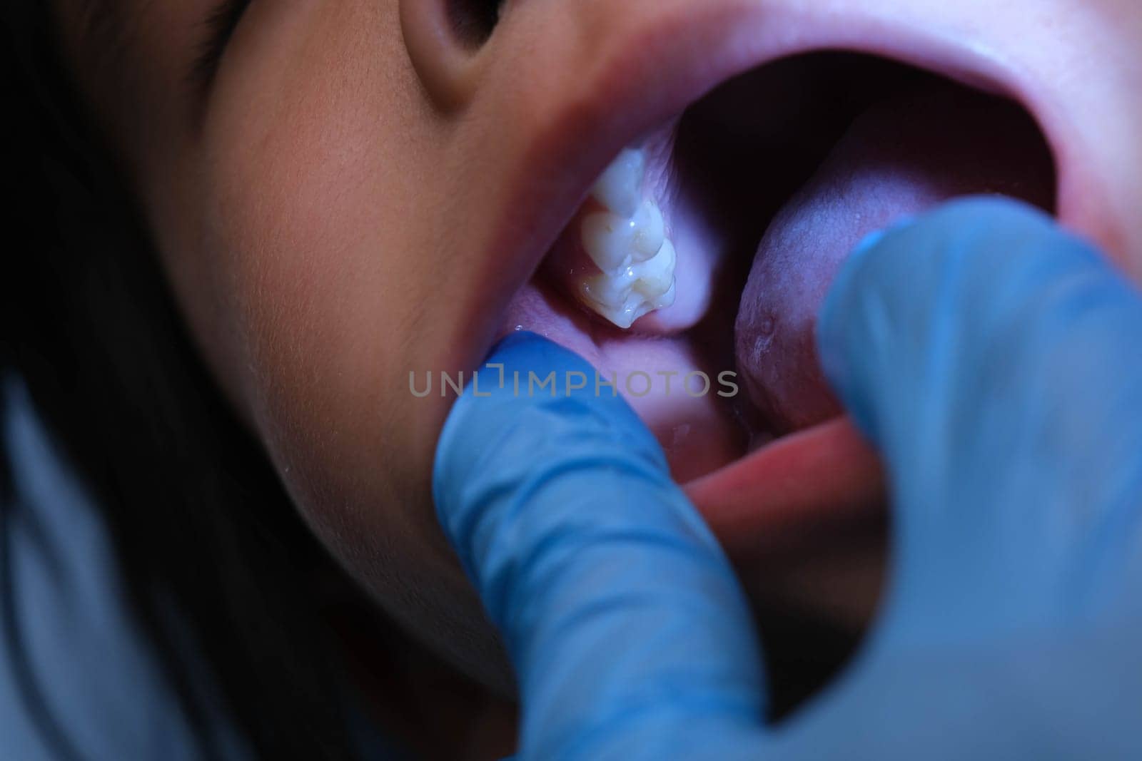 Close-up inside the oral cavity of a healthy child with beautiful rows of baby teeth. Young girl opens mouth revealing upper and lower teeth, hard palate, soft palate, dental and oral health checkup.