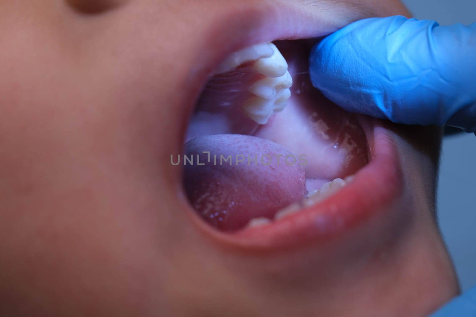 Close-up inside the oral cavity of a healthy child with beautiful rows of baby teeth. Young girl opens mouth revealing upper and lower teeth, hard palate, soft palate, dental and oral health checkup. by TEERASAK