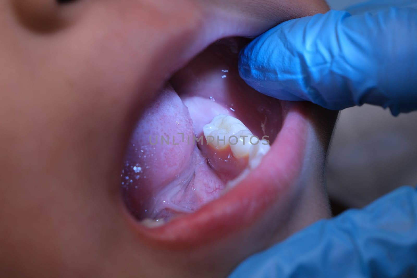 Close-up inside the oral cavity of a healthy child with beautiful rows of baby teeth. Young girl opens mouth revealing upper and lower teeth, hard palate, soft palate, dental and oral health checkup.