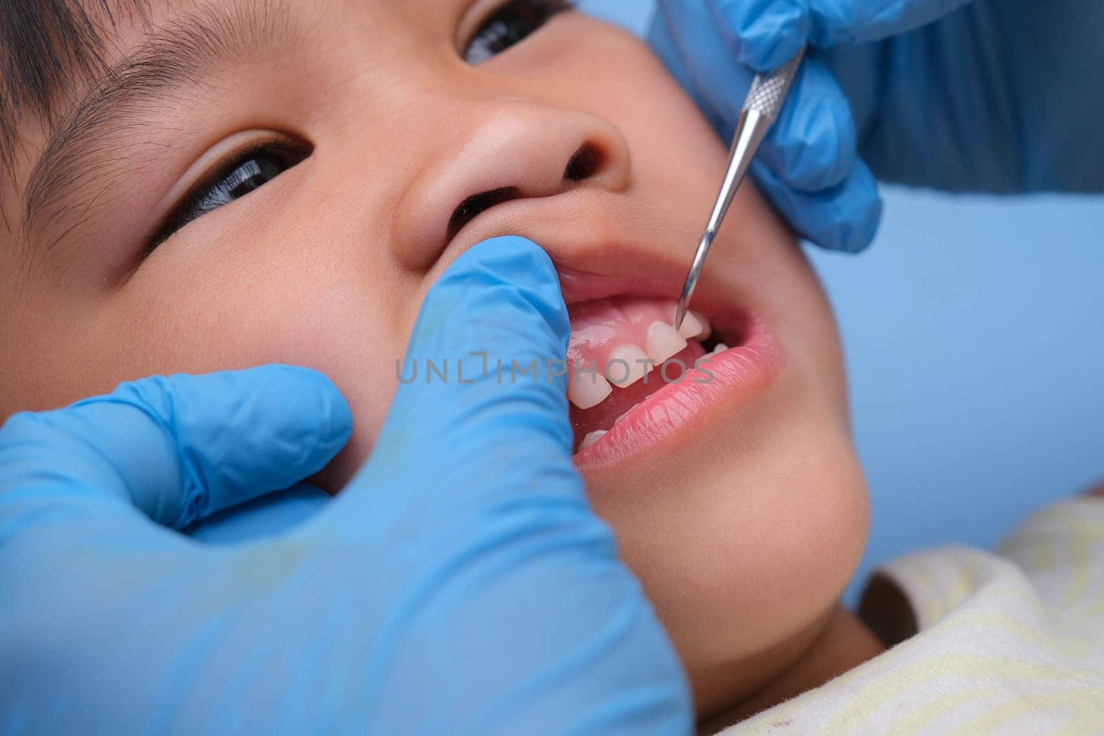 Close-up in the oral cavity of a healthy child with beautiful white teeth. Young girl opens her mouth to reveal healthy teeth, hard and soft palate. Dental and oral health check by TEERASAK