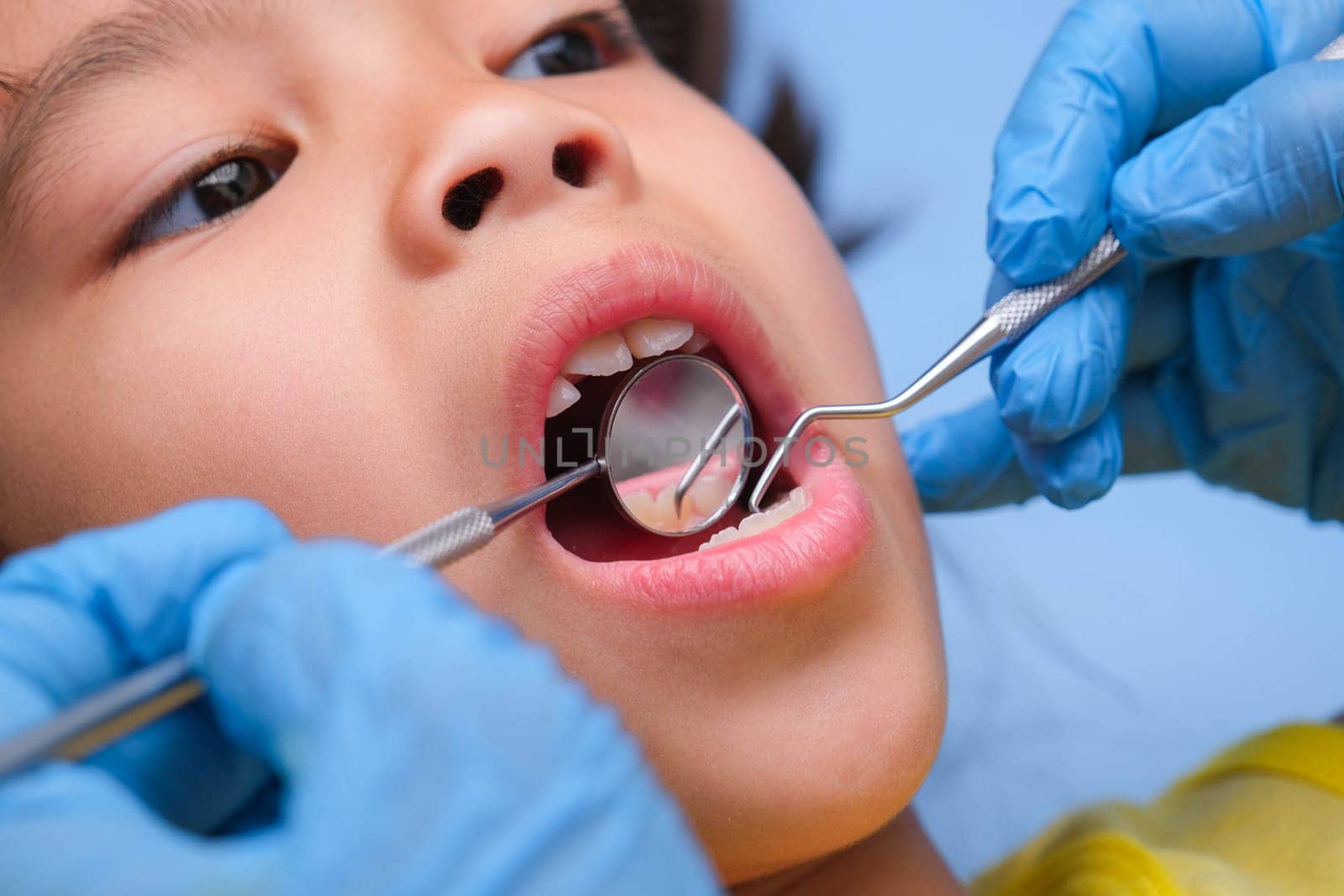 Close-up in the oral cavity of a healthy child with beautiful white teeth. Young girl opens her mouth to reveal healthy teeth, hard and soft palate. Dental and oral health check